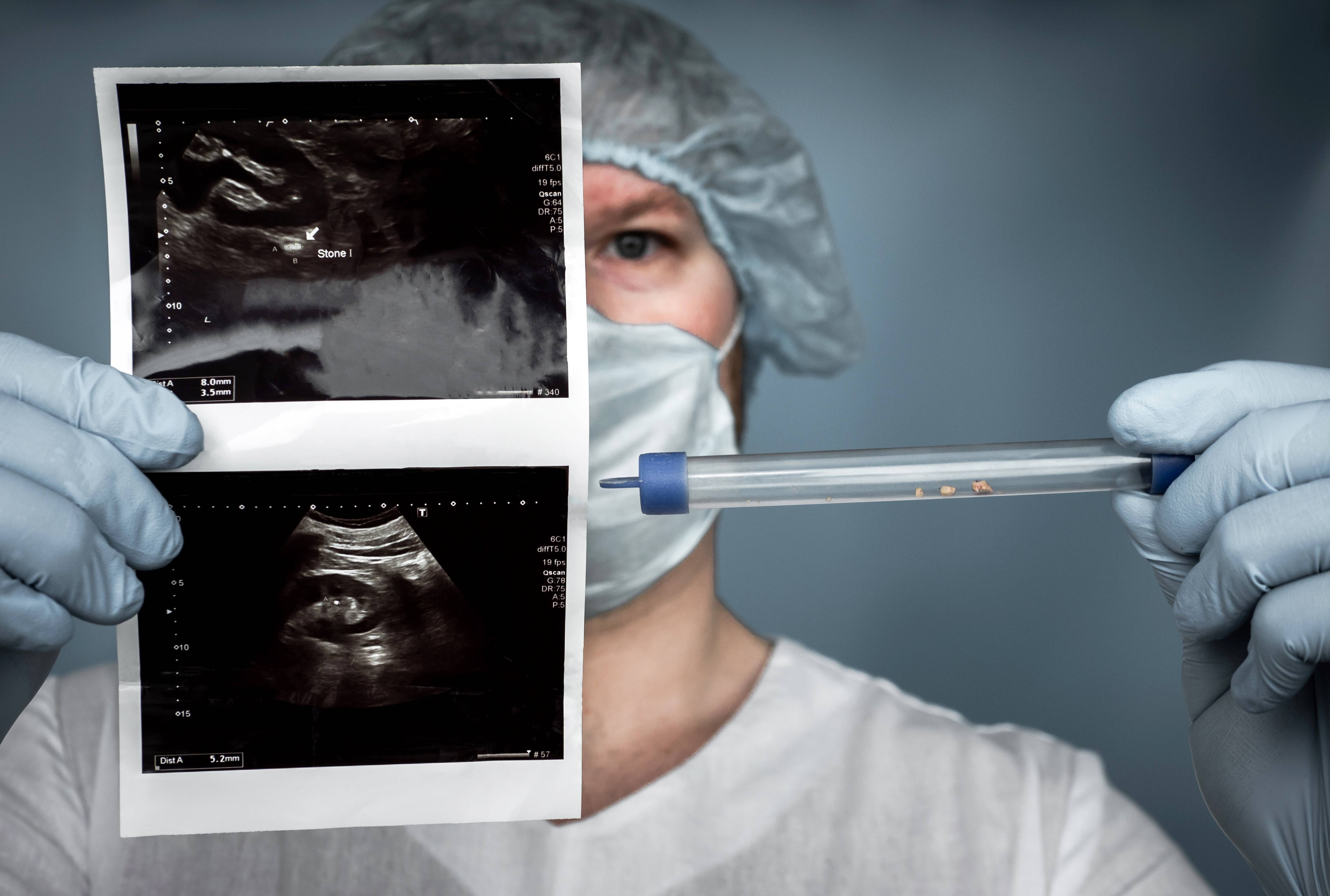 Immagine: calcolosi urinaria .jpg Creative Commons Attributon–ShareAlike 4.0 International (CC BY-SA 4.0)